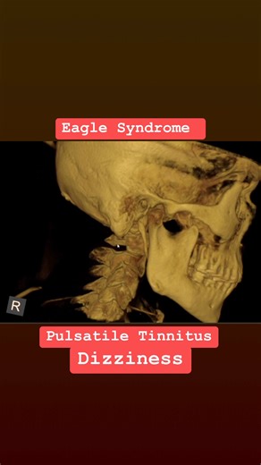 575K views · 4.5K reactions | Eagle Syndrome, Pulsatile Tinnitus, dizziness, lightheadedness and other symptoms. Comment below to find a doctor near you! #vertigo #dizziness #pulsatiletinnitus #fyp | Upper Cervical Chiropractor Near Me | Facebook