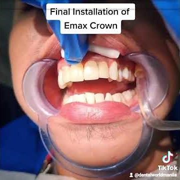 Final Installation of E-max porcelain crown.