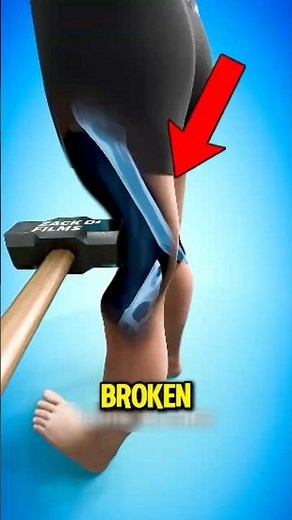 Broken Bone Here’s What Really Happens Inside 😱