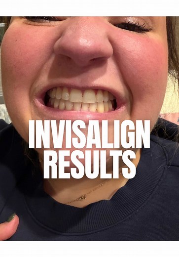 Transform Your Smile: Invisalign Before and After Results