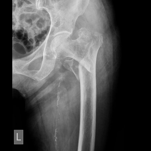 Intertrochanteric Fractures
