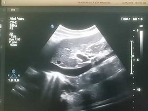 Collapsing IVC (Hypovolemia)