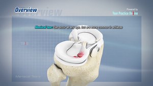 Meniscal Tears