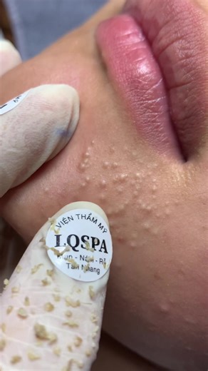 Chăm Sóc Da Mụn Hiệu Quả Với Eucerin Pro Acne