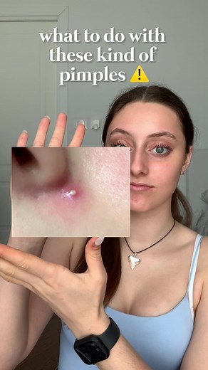 Effective Ways to Treat Big Pimples on Face Naturally