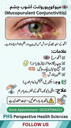 Mucopurulent Conjunctivitis | Bacterial Pink Eye