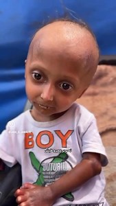 Four-year-old Hala Al-Hanadi suffers from a rare disease called systemic scleroderma. Her fragile body was on the path to recovery-until the war stopped everything. Today, Hala is deprived of travel, treatment, and even basic nutrition. She weighs barely 6 kilograms, and the disease is silently consuming her. | PBI Story