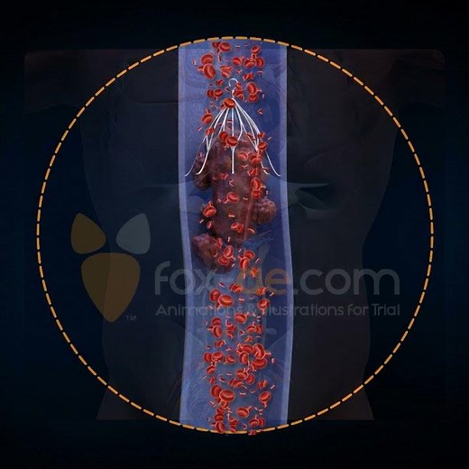 Inferior Vena Cava Filter