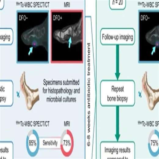 WBC SPECT/CT Beats MRI for Foot Osteomyelitis #Shorts
