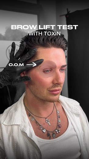 112K views · 392 reactions | Brow Lift with Toxin — Not for Everyone...
