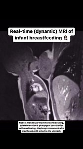 Real-time MRI imaging was successful in capturing dynamic images of the breastfeeding swallow! This imaging modality confirms the dorsal surface of the infant's tongue elevates the maternal nipple to the hard palate, closing the space around the nipple with no air visible in the oral cavity during sucking and swallowing. Breastmilk was easily visualized, being high intensity on T2 sequences. Simply incredible Ph.D. research by Dr. Nikki Mills, of University of Aukland, New Zealand. These images 