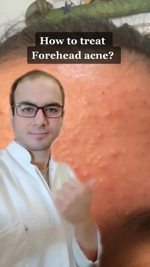 Effective Forehead Acne Treatment Life Hacks for Clear Skin