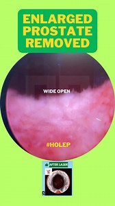 275 reactions · 13 shares | HoLEP before and after. #docdrew #urologist #urology #Tacurong #prostate #BPH #enlargedprostatetreatment | Doc Drew Valdez - Urology | Facebook