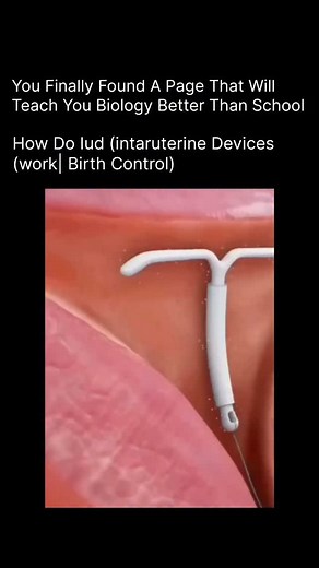 BIOLOGY | MEDICAL | HEALTH on Instagram: "💠 How Do IUDs Work? (Birth Control Explained) An IUD (Intrauterine Device) is a small, T-shaped device placed inside the uterus to prevent pregnancy. It works in two main ways: 1️⃣ Hormonal IUDs release progestin, which thickens cervical mucus to block sperm and thins the uterine lining — making it hard for an egg to implant. 2️⃣ Copper IUDs release copper ions that are toxic to sperm — stopping them from reaching the egg. ✨ It’s over 99% effective, lon