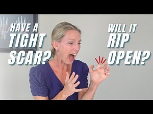 Is Tight Scar Tissue Limiting Movement of Your Hand or Finger? Get 3 Tight Scar Tissue Treatments