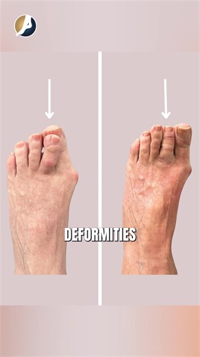 Is that toe bothering you more than you'd like to admit? You might be dealing with a hammer toe — and the good news is, there are real solutions. 👇 A hammer toe occurs when an abnormal bend develops in the middle joint of a toe, causing pain, pressure, and difficulty with footwear. It can affect your daily comfort and get worse over time if left untreated. Whether it's conservative care or a surgical solution, Dr. Wadehra can help you find relief and get back on your feet. 📍 The Art of Foot an