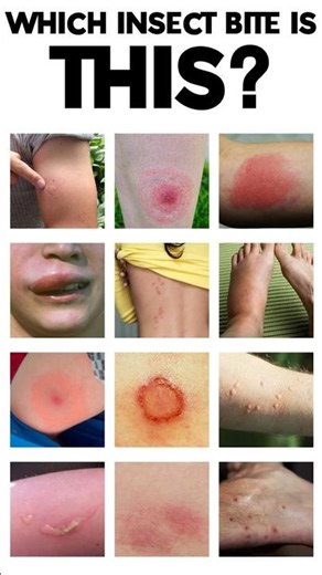 Insect Bites 🐞 | Can You Guess the Insect? #insects #shorts