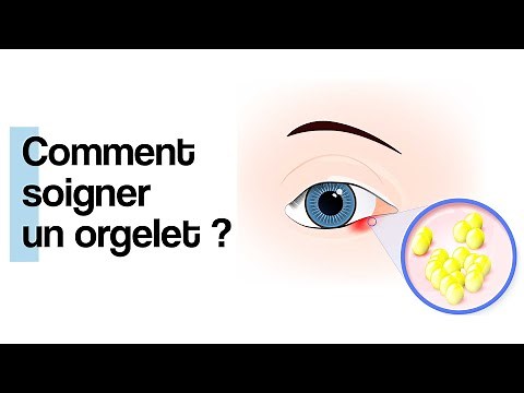 Comment soigner un orgelet ?
