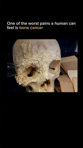 Bone cancer is considered one of the most painful conditions a person can experience 🎗️💔🩺