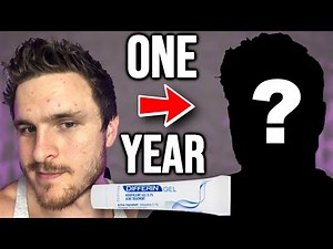 I Tried Differin For ONE YEAR & Here's What Happened!