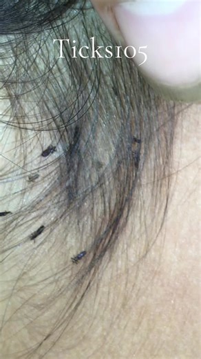 Remove lice #😱😱😱omg #😭😭😭 #🥶🥶🥶 #😂😂😂 #liceremoval