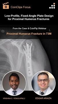 Low-Profile, Fixed-Angle Plate Design for Proximal Humerus Fractures