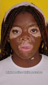 vitiligo caused by chronic anxiety disorders