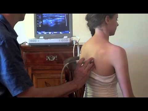 Ultrasound scanning of shoulder impingement.m4v