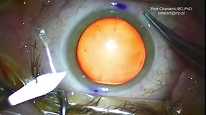 Toric IOL Analog Axis Marking Technique - Eyetube