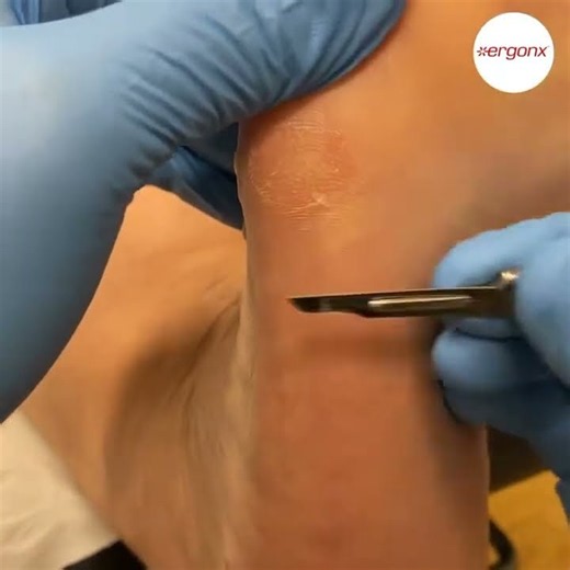 Satisfying Hard Corn Removal by Podiatrist Must-Watch Foot Care #Podiatry #CornRemoval #FootHealth