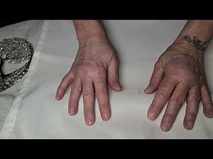 Here is an update on how I am doing. Thank you for caring and all your kind comments.