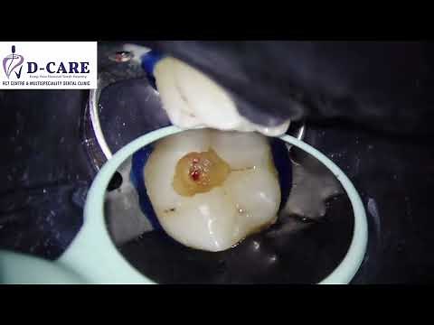 Tooth Pain? You Might Not Need a Root Canal! Discover the Magic of Pulp Capping ✨