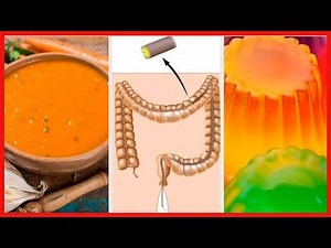 ¿Cuál es la dieta y preparación previa a una colonoscopia?