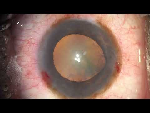 Puresee IOL, Zonular Dialysis, CTR, Ant Vit