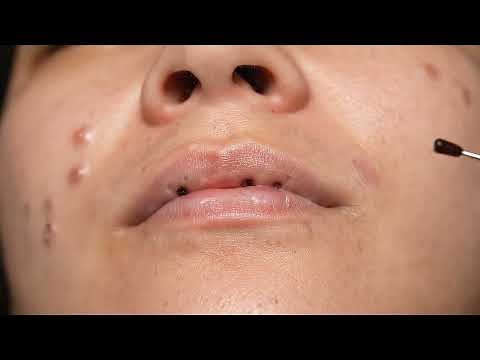 SHOCKING Pain-Free Blackhead Removal: Get INSTANT Clear Skin! ✨🤯