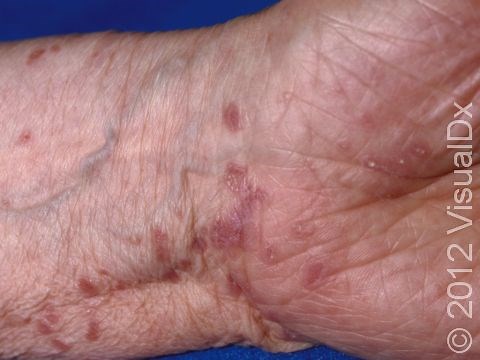 Lichen Planus Condition, Treatments and Pictures for Adults