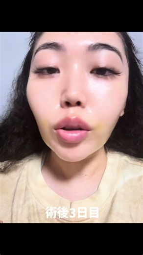 驚くほどダウンタイム最小限 脂肪吸引エキスパートドクター小野先生の脂肪吸引