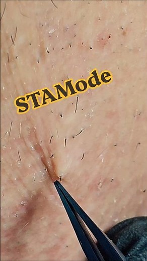 Beard Hair Plucking Close-Up — Tweezing ASMR 🧔 #beard #tweezing #plucking #satisfying #fyp