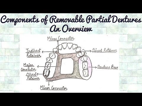 Components of Removable Partial Dentures - An Overview