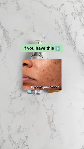 Clinique Skincare for Hyperpigmentation and Acne: What to Use