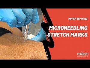 STRETCH MARKS MICRONEEDLING PROCEDURE | MDPEN TRAINING