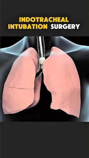 Endotracheal Intubation Explained. life saving airway procedure (3d Animations) #endotrachealintubat