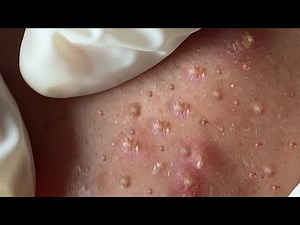 Make your Acne Treatment Huong Da Nang | 458# acne 2022