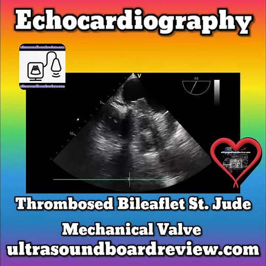 St. Jude Bileaflet Mitral Mechanical Valve with Thrombus