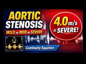 Aortic Stenosis Explained | Peak Velocity, Mean Gradient,AVA by Continuity Equation Echo Made Simple