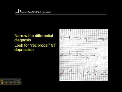 12-15 Lead ECG: Reciprical Changes