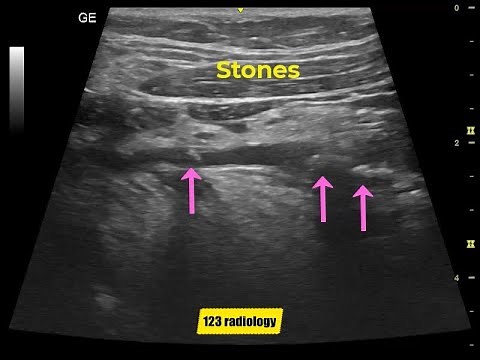 Submandibular duct stones
