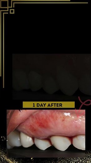 How the Gums Look 1 Day After Pinhole Surgical Technique®