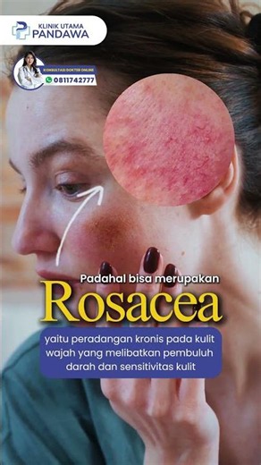 Red Face Resembling Acne? Beware of Rosacea
