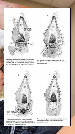 Missing labias, still missing. Idk why I think they’ll magically appeared. Also surgery to fix my posterior commisure band was a big topic in today’s appointment and I was shocked to hear that it wasn’t a simple snip and heal after a couple days 😔 Lichen sclerosis is such under undiagnosed and often times misdiagnosed condition. Many OBGYNs think it’s chronic yeast infections or BV! So if you are continuing to have itching, irritation, burning, overall uncomfortable feeling down there and no me